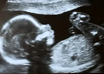 بررسی تخصصی علل و پیامدهای سکسکه جنین